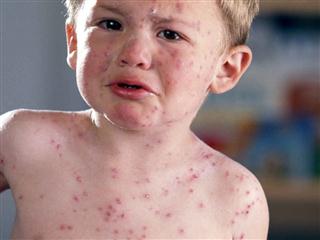 Georgia’s measles was brought in to Armenia from Odessa