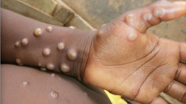 No room for complacency: Monkeypox cases have tripled in the European Region over the past two weeks